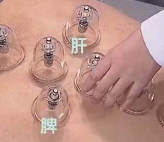 排寒利湿的拔罐方式