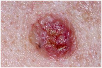 直肠癌皮肤症状图片图片